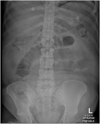 Uncommon presentation of complicated internal hernia through the appendices epiploicae ring of adhesion: a clinical case study